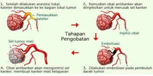 pengobatan-kanker-payudara-langkah-menuju-pemulihan